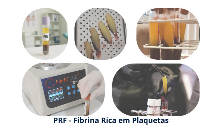 PRF - Fibrina Rica em Plaquetas